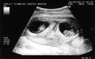 Норма прогестерона при беременности на ранних сроках (таблица)