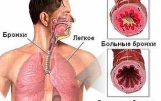 Острый бронхит, лечение народными средствами