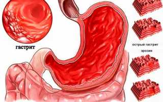 Можно ли вылечить хронический гастрит навсегда