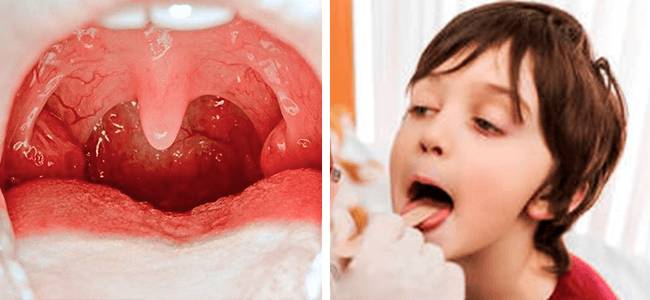 Аденоиды и осмотр ребенка