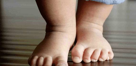 Искривление стоп