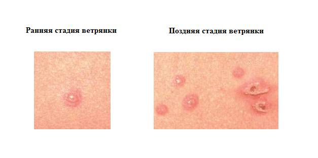 Стадии заболевания