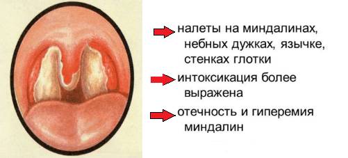 Появление налета на миндалинах