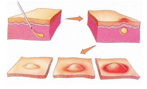 Реакция на укол