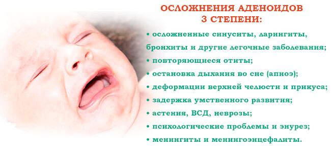 Осложнения аденоидов 3 степени у ребенка