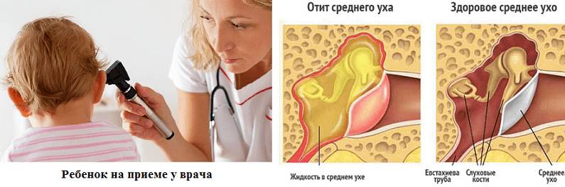 Воспаление в ушах