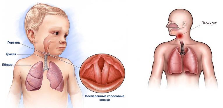 Болезнь у детей
