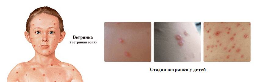 Ветряная оспа у детей
