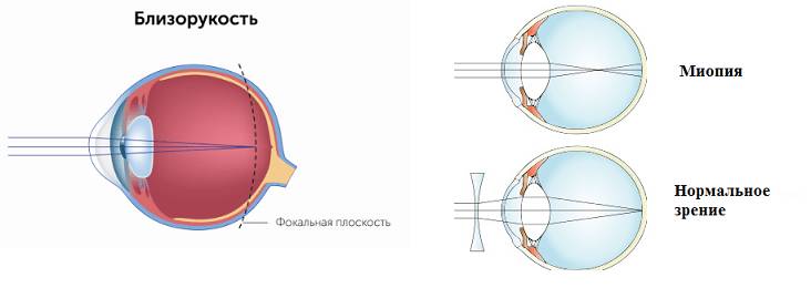 Развитие заболевания