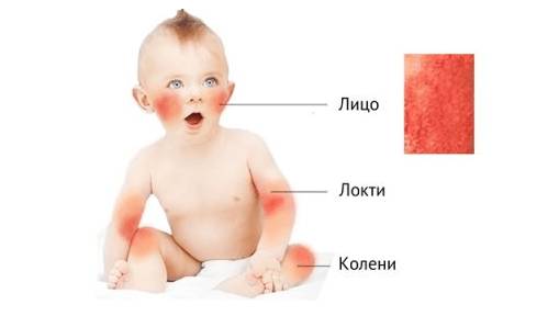 Аллергия у ребенка