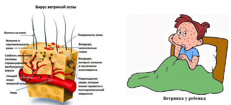 Симптомы заболевания