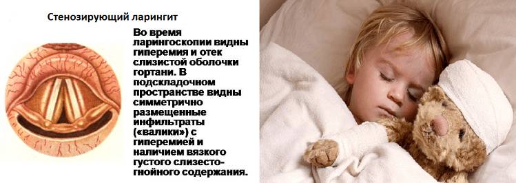 Острый стенозирующий ларинготрахеит