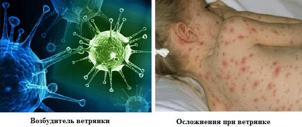 Появление осложнений при заболевании у детей
