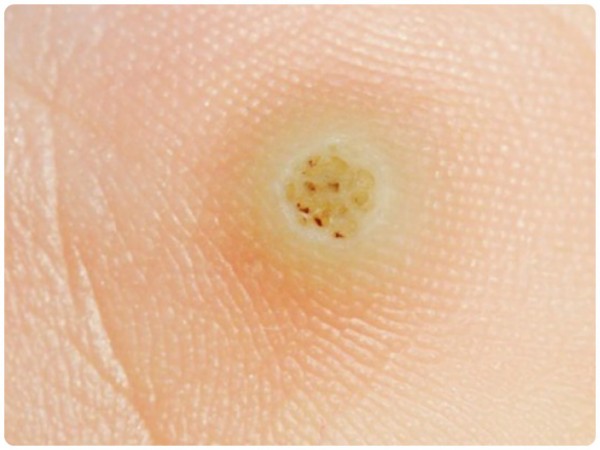 как выглядит шипица на ноге