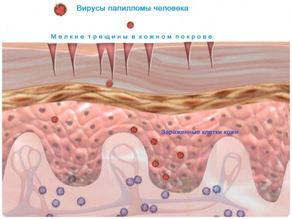впч в верхнем слое эпителии