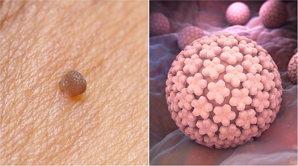 анестезия перед удалением папилломы