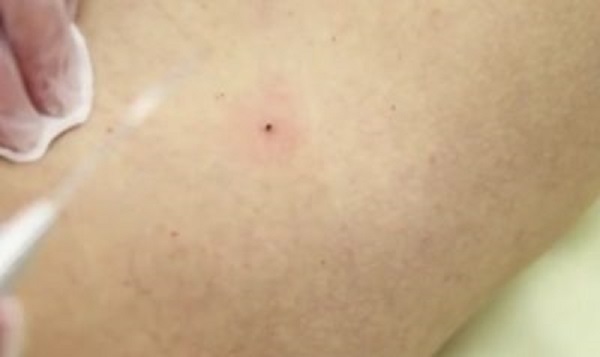 струп после удаления папилломы