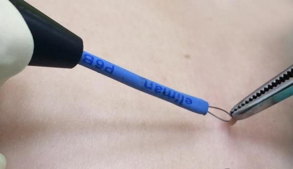 удаление висячих папиллом радиоволновым методом