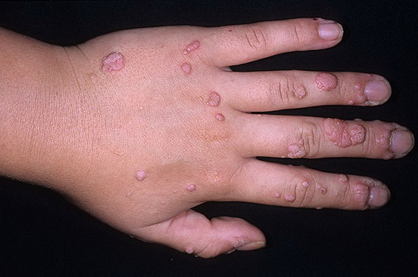 вульгарные папилломы у детей