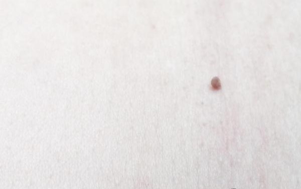 до удаления папилломы сургитроном