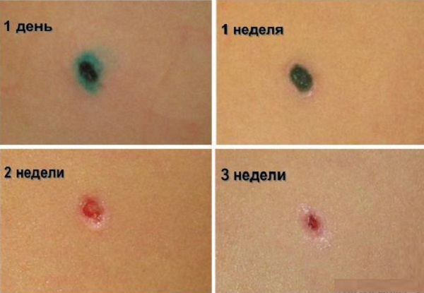 после электрокоагуляции папиллом