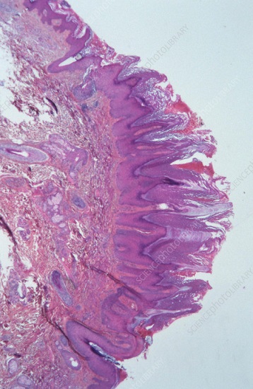 Гиперкератоз папилломы под микроскопом гистология