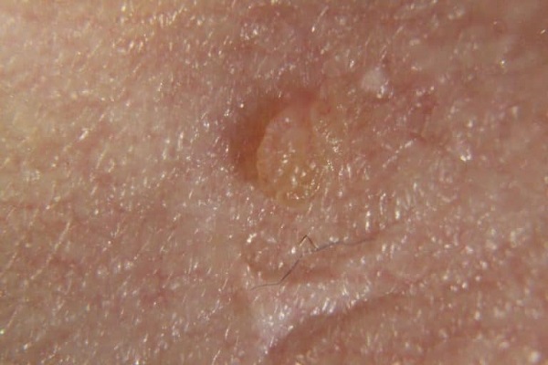 наросты телесного цвета