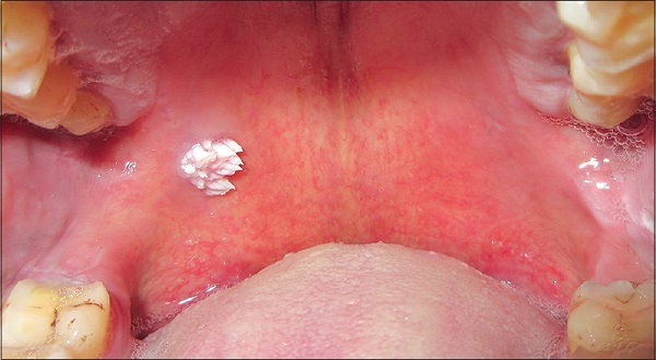 Плоскоклеточная папиллома мягкого неба