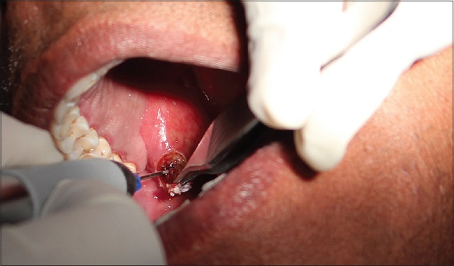 лазерное удаление плоскоклеточной папилломы