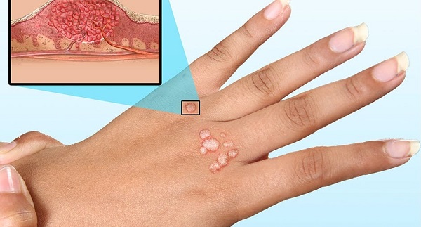 причины появления папиллом на руке