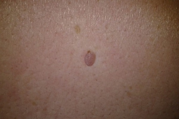 плоская папиллома