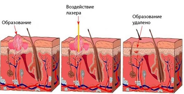 воздействие лазера на папиллому