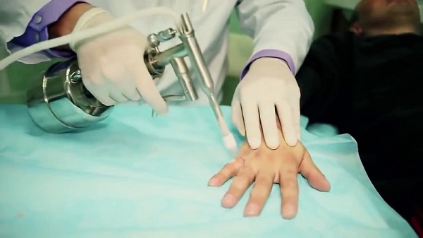 удаление папиллом на руках жидким азотом