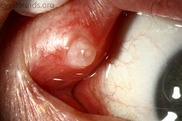 плоскоклеточная папиллома века глаза