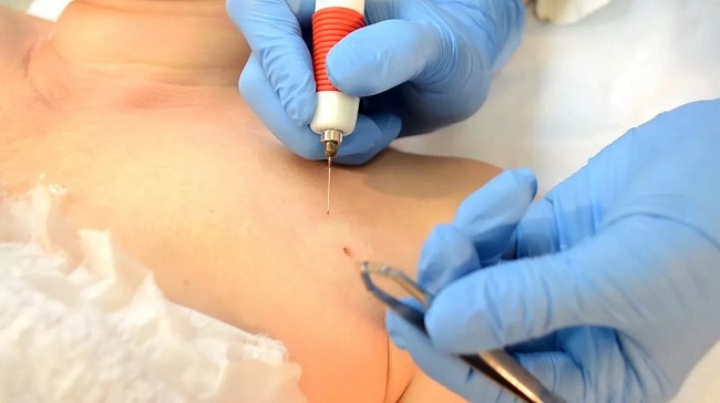 удаление папилломы электрокоагуляцией