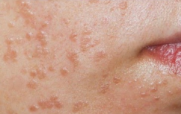 плоские бородавки на лице