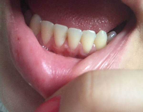 как выглядят папилломы на десне