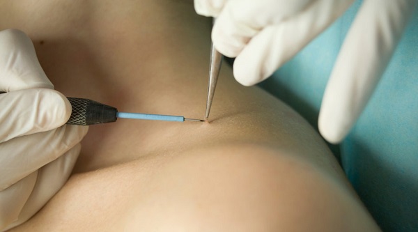 удаление папилломы с шеи