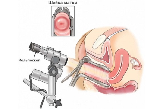 фото: колькоскоп и впч