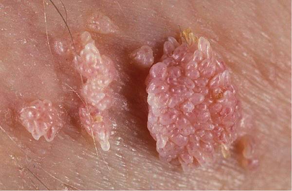 фото: остроконечные кондиломы