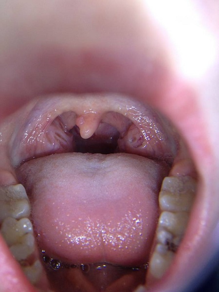 папилломатоза гортани у детей