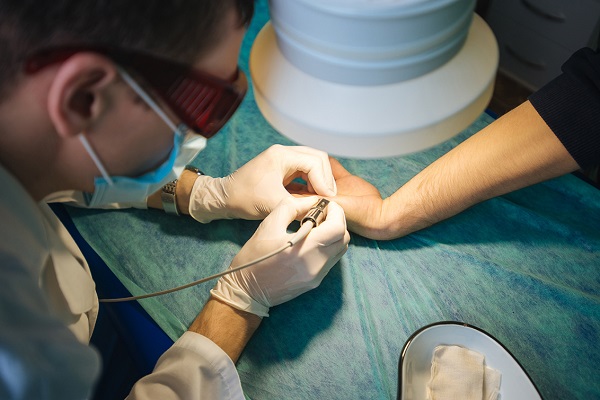 электрокоагуляция папиллом на руке