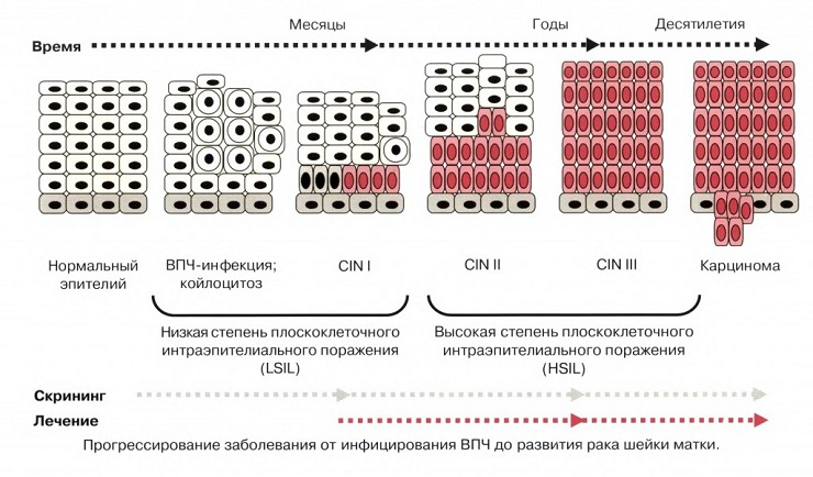стадии развития впч 16 и 18 типа