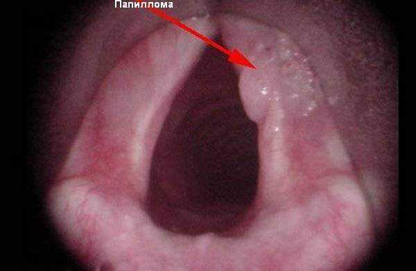папилломы в гортани у ребенка