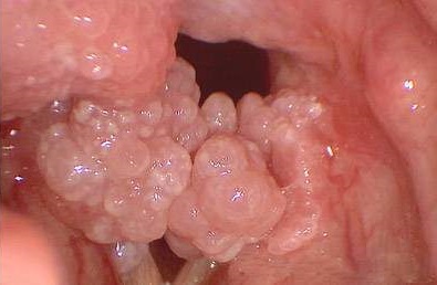 папилломатоз гортани