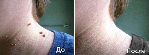 до и после удаления папиллом лазером