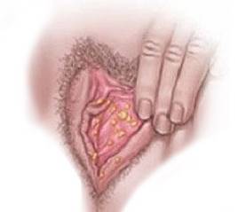 папилломы на половых губах у женщин