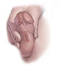 папилломы у мужчин на половых органах