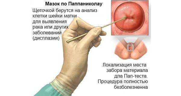 фото: диагностика впч