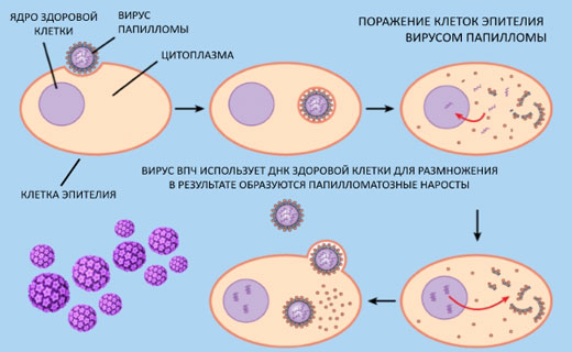 фото: заражение вирусом папилломы человека